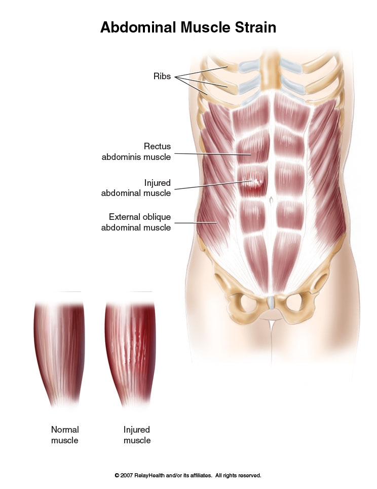 Abdominal Muscle Strain: Illustration