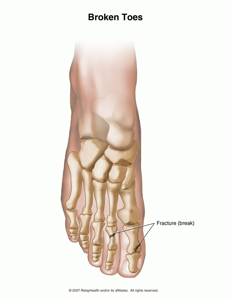 Broken Toe: Illustration