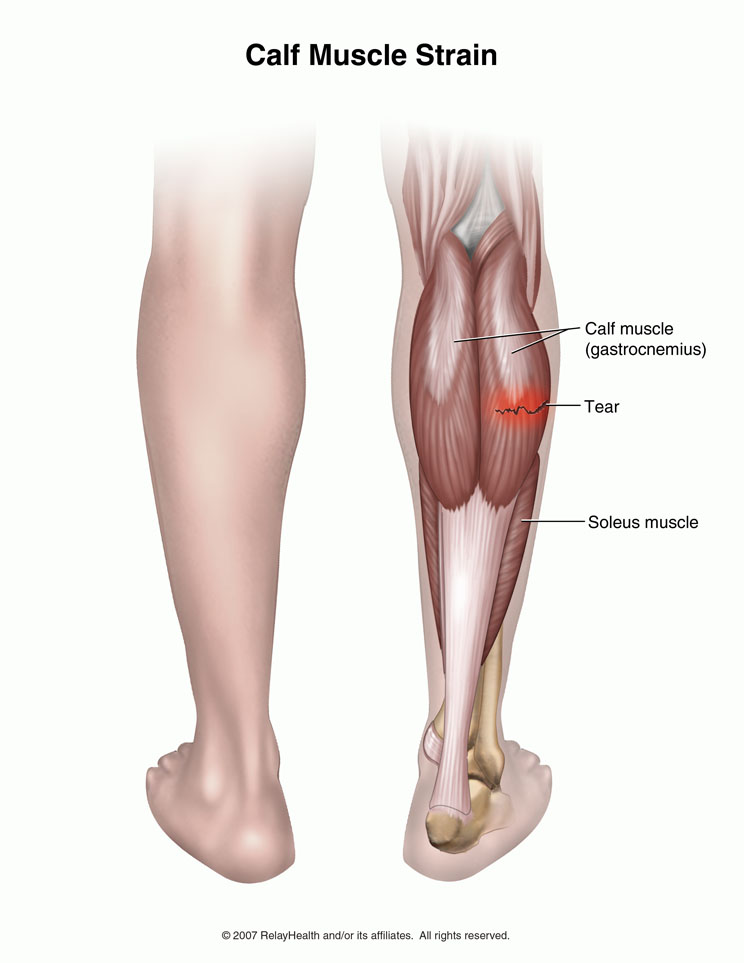 Calf Strain: Illustration