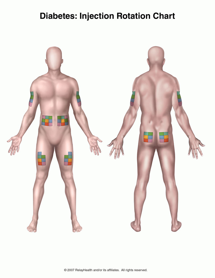 Diabetes, Injection Rotation Chart: Illustration