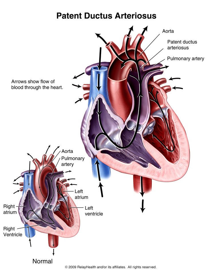 Patent Ductus Arteriosus: Illustration