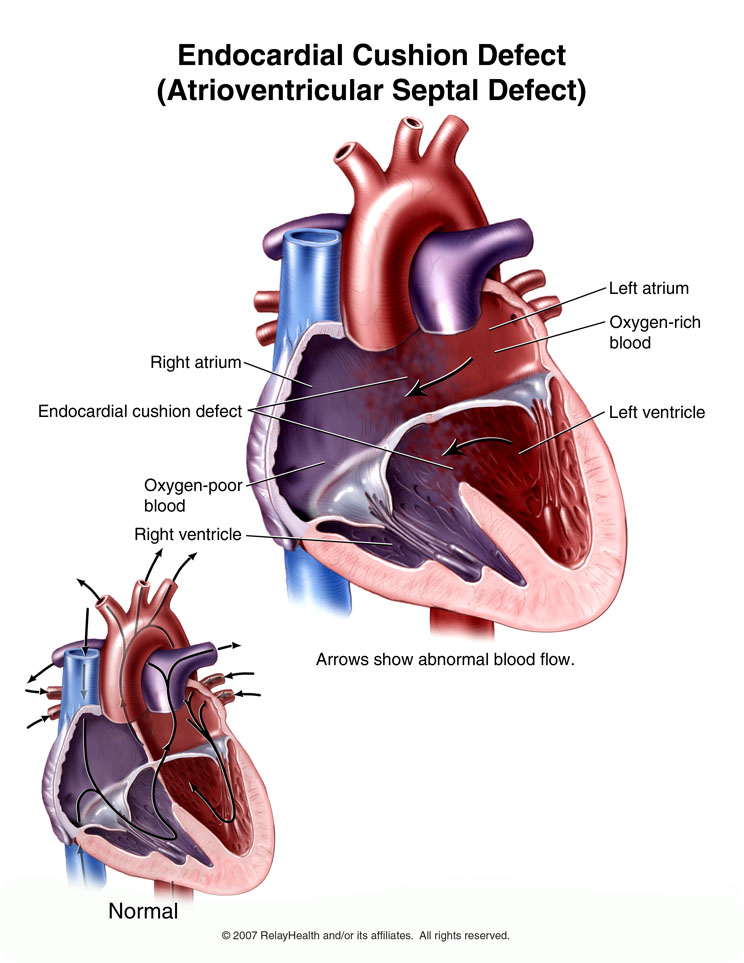 Endocardial Cushion Defect: Illustration