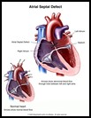 Thumbnail image of: Atrial Septal Defect: Illustration