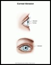 Thumbnail image of: Corneal Abrasion: Illustration