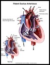 Thumbnail image of: Patent Ductus Arteriosus: Illustration