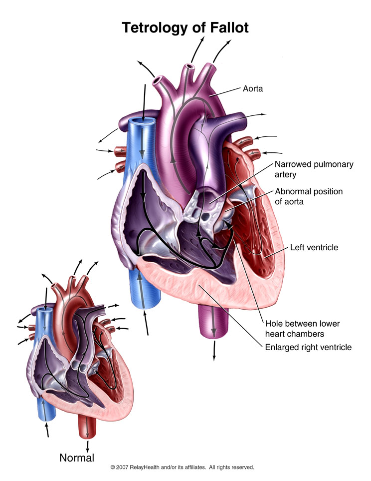 Tetralogy of Fallot: Illustration