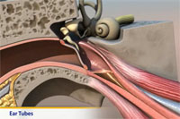 Thumbnail image of: Ear Infection and Tubes (pediatric)