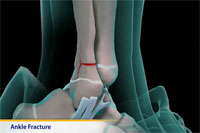 Thumbnail image of: Ankle Fracture (pediatric)