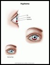 Thumbnail image of: Hyphema: Illustration