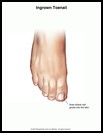 Thumbnail image of: Ingrown Toenail: Illustration