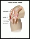 Thumbnail image of: Osgood-Schlatter Disease: Illustration