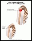 Thumbnail image of: Little Leaguer's Shoulder: Illustration