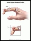 Thumbnail image of: Mallet Finger (Baseball Finger): Illustration