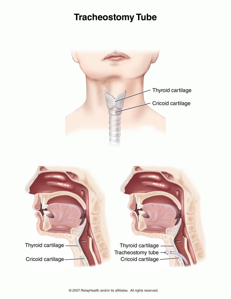 Tracheostomy Tube: Illustration