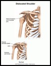 Thumbnail image of: Shoulder Dislocation: Illustration