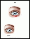 Thumbnail image of: Stye: Illustration