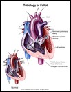 Thumbnail image of: Tetralogy of Fallot: Illustration