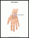 Thumbnail image of: Wrist Sprain: Illustration