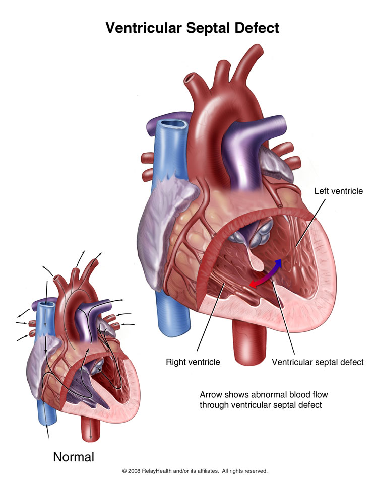 Ventricular Septal Defect: Illustration